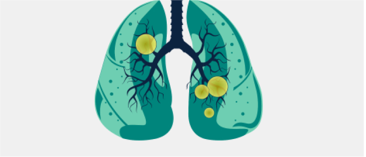 Neumonía neumocócica no bacteriémica
